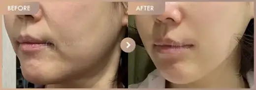 ONDA lifting: before-and-after comparison at Newstar Clinic