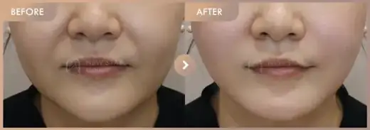 ONDA lifting: before-and-after comparison at Newstar Clinic