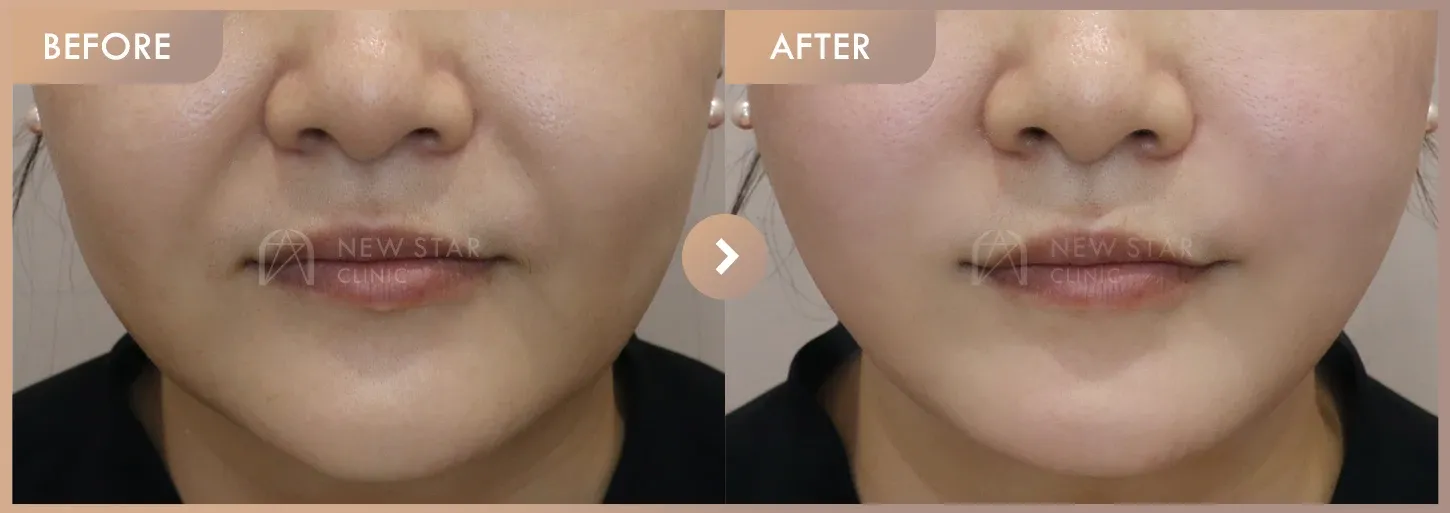ONDA lifting before-and-after photos at Newstar Clinic
