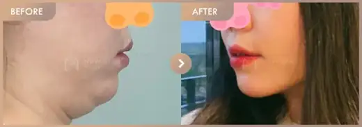 Energy-based lifting: before-and-after comparison at Newstar Clinic