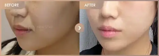 ONDA lifting: before-and-after comparison at Newstar Clinic