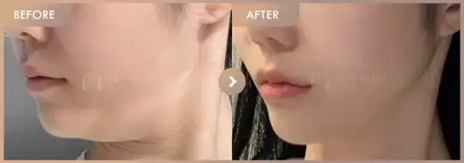 ONDA lifting: before-and-after comparison at Newstar Clinic
