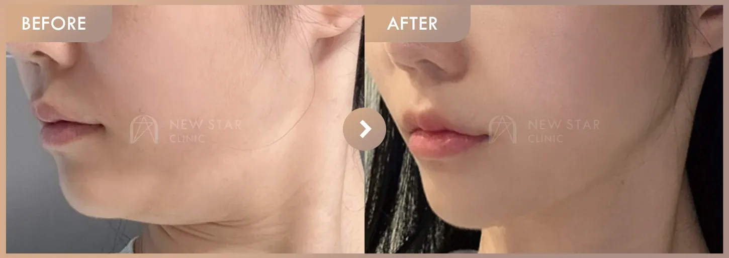ONDA lifting before-and-after photos at Newstar Clinic