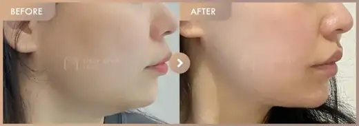 ONDA lifting: before-and-after comparison at Newstar Clinic