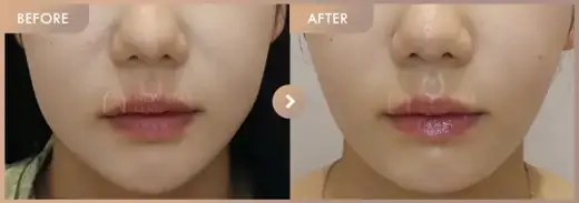 ONDA lifting: before-and-after comparison at Newstar Clinic