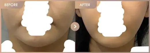 ONDA lifting: before-and-after comparison at Newstar Clinic