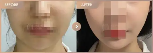 ONDA lifting: before-and-after comparison at Newstar Clinic