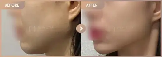 ONDA lifting: before-and-after comparison at Newstar Clinic