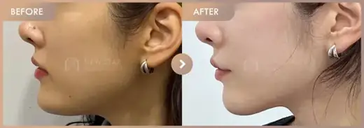 ONDA lifting: before-and-after comparison at Newstar Clinic