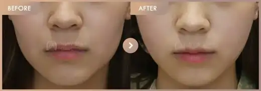 ONDA lifting: before-and-after comparison at Newstar Clinic
