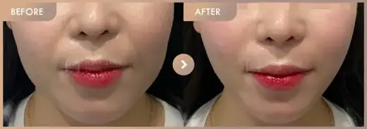 ONDA lifting: before-and-after comparison at Newstar Clinic