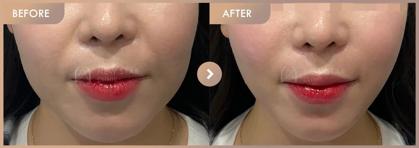 ONDA lifting before-and-after photos at Newstar Clinic