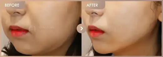 Energy-based lifting: before-and-after comparison at Newstar Clinic