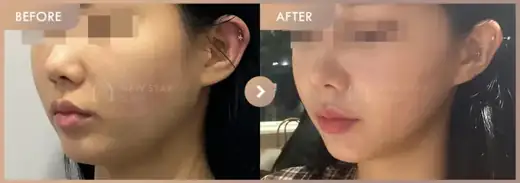 ONDA lifting: before-and-after comparison at Newstar Clinic