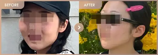 ONDA lifting: before-and-after comparison at Newstar Clinic
