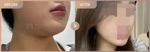 ONDA lifting: before-and-after comparison at Newstar Clinic