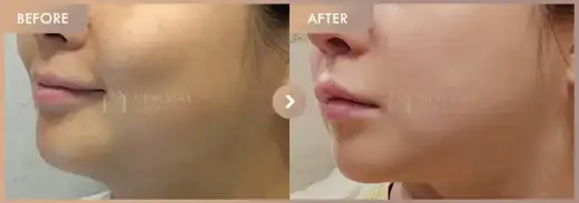 ONDA lifting: before-and-after comparison at Newstar Clinic