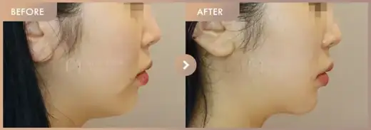 ONDA lifting: before-and-after comparison at Newstar Clinic