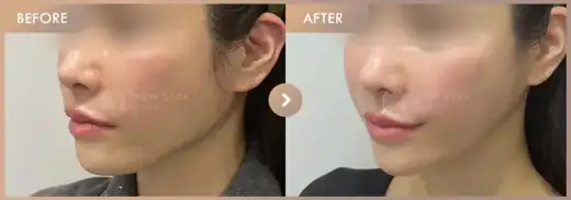 ONDA + Titanium + Ultherapy: before-and-after comparison at Newstar Clinic