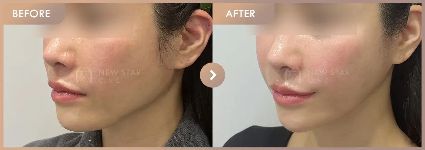 ONDA + Titanium + Ultherapy before-and-after photos at Newstar Clinic