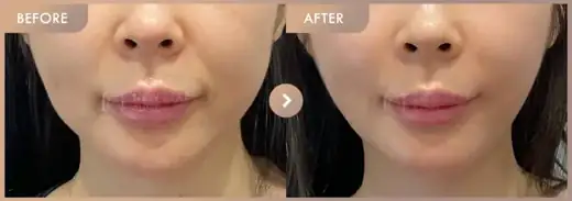 ONDA lifting: before-and-after comparison at Newstar Clinic