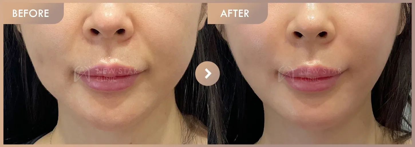 ONDA lifting before-and-after photos at Newstar Clinic