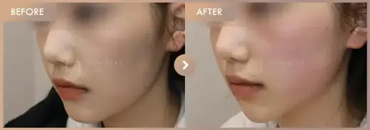 ONDA lifting: before-and-after comparison at Newstar Clinic