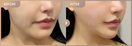 ONDA lifting: before-and-after comparison at Newstar Clinic
