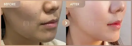 ONDA + Titanium + Ultherapy: before-and-after comparison at Newstar Clinic