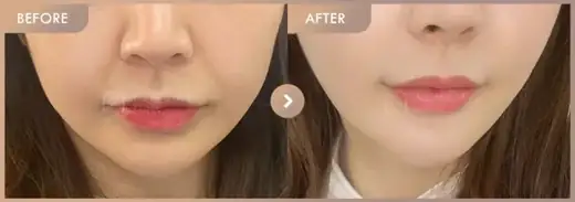 Titanium lifting · Front view: before-and-after comparison at Newstar Clinic