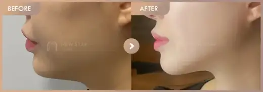 ONDA lifting: before-and-after comparison at Newstar Clinic