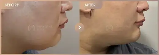 Energy-based lifting: before-and-after comparison at Newstar Clinic