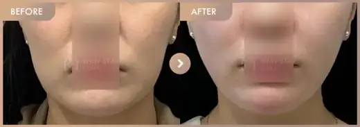 ONDA lifting: before-and-after comparison at Newstar Clinic