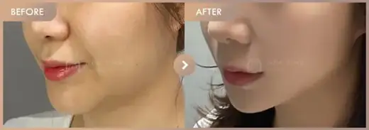 ONDA lifting: before-and-after comparison at Newstar Clinic