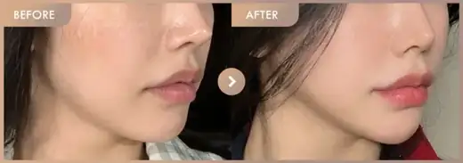 ONDA lifting: before-and-after comparison at Newstar Clinic
