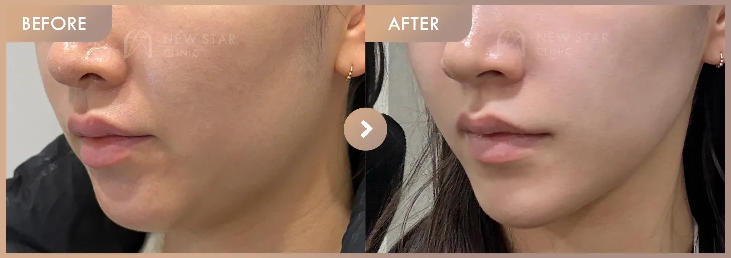 ONDA lifting before-and-after photos at Newstar Clinic