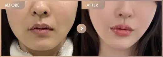 ONDA lifting: before-and-after comparison at Newstar Clinic
