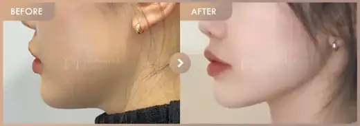 ONDA + Titanium + Ultherapy: before-and-after comparison at Newstar Clinic