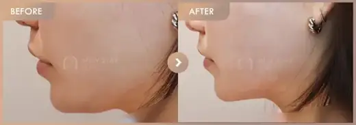 InMode full-face: before-and-after comparison at Newstar Clinic