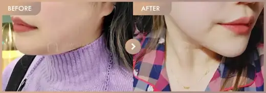 Energy-based lifting: before-and-after comparison at Newstar Clinic