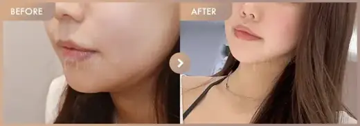 Energy-based lifting: before-and-after comparison at Newstar Clinic
