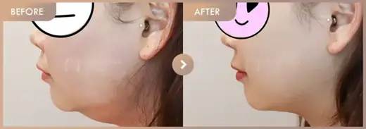 Energy-based lifting: before-and-after comparison at Newstar Clinic
