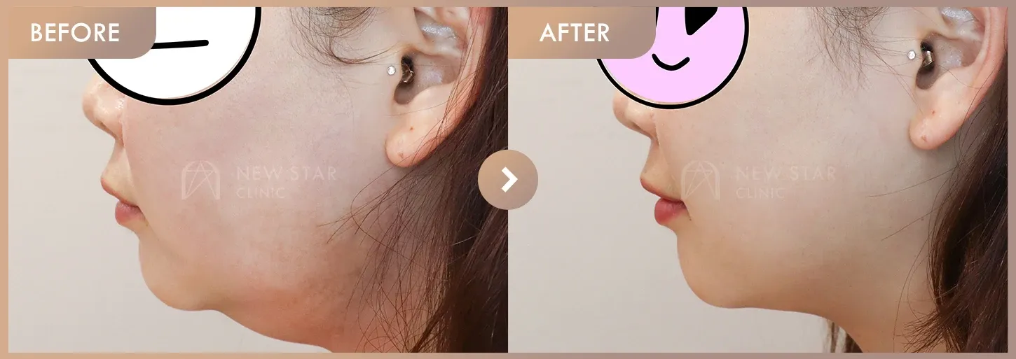 Energy-based lifting before-and-after photos at Newstar Clinic