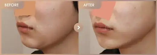 Energy-based lifting: before-and-after comparison at Newstar Clinic
