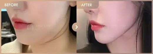 Energy-based lifting: before-and-after comparison at Newstar Clinic