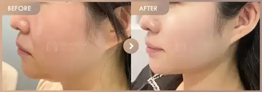 Energy-based lifting: before-and-after comparison at Newstar Clinic