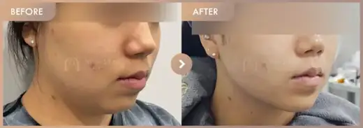 ONDA lifting + Titanium lifting: before-and-after comparison at Newstar Clinic
