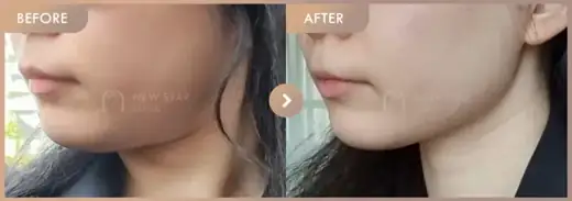 Titanium lifting: before-and-after comparison at Newstar Clinic