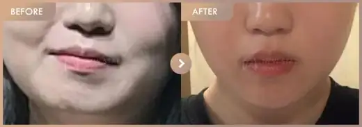 Energy-based lifting: before-and-after comparison at Newstar Clinic