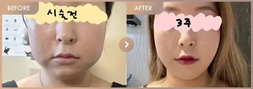 Energy-based lifting: before-and-after comparison at Newstar Clinic